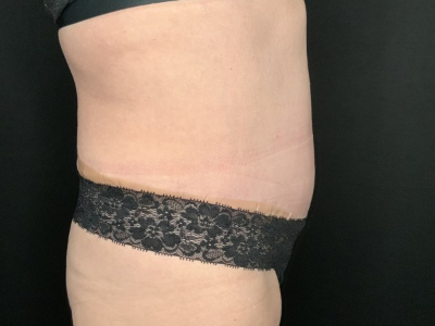 Patient #45698: Tummy Tuck with Liposuction to Flanks, Hips, and Abdomen After Image