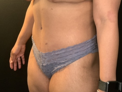 Patient #78963: Tummy Tuck with Liposuction to Flanks After Image
