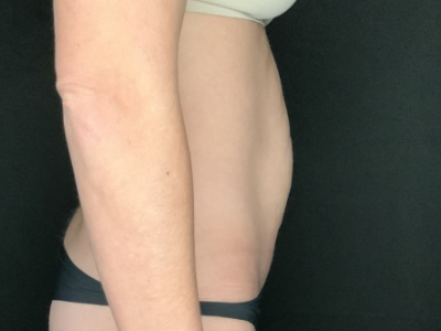 Patient #12339: Tummy Tuck Before Image