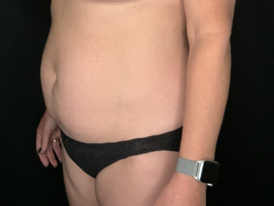 Patient #89658: Tummy Tuck with Liposuction to Flanks Before Image