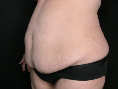 Patient #69856: Tummy Tuck with Liposuction to Flanks Before Image