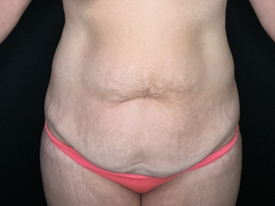 Patient #96587: Tummy Tuck with Liposuction to Flanks Before Image