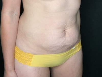 Patient #56985: Tummy Tuck with Flank Liposuction Before Image