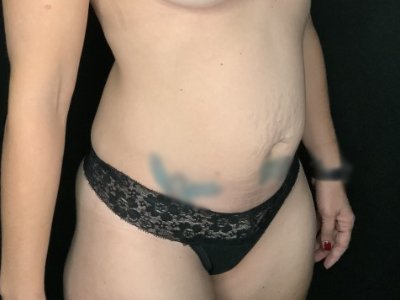 Patient #45696: Tummy Tuck Before Image