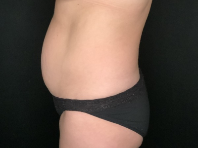 Patient #89658: Tummy Tuck with Liposuction to Flanks Before Image