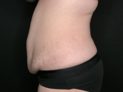 Patient #69856: Tummy Tuck with Liposuction to Flanks Before Image
