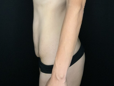 Patient #67891: Tummy Tuck Before Image