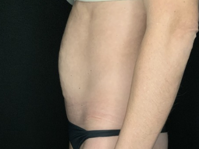 Patient #12339: Tummy Tuck Before Image