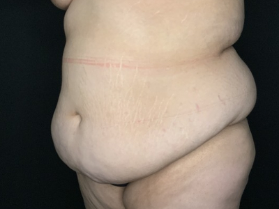 Patient #23698: Tummy Tuck with Liposuction to Flanks and Back Before Image