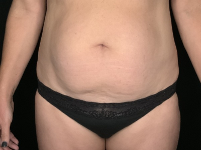 Patient #89658: Tummy Tuck with Liposuction to Flanks Before Image