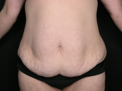 Patient #69856: Tummy Tuck with Liposuction to Flanks Before Image