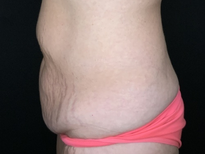 Patient #96587: Tummy Tuck with Liposuction to Flanks Before Image