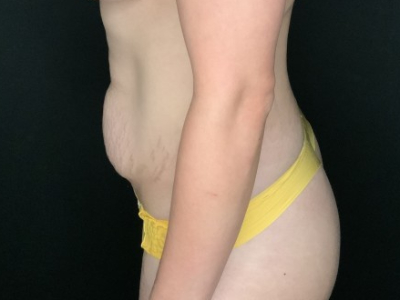 Patient #56985: Tummy Tuck with Flank Liposuction Before Image