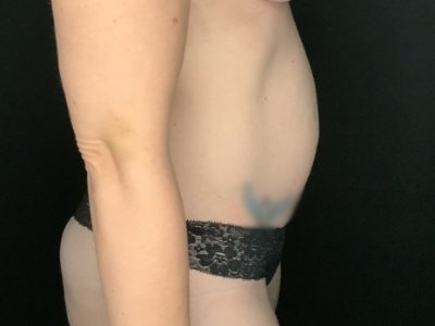 Patient #45696: Tummy Tuck Before Image