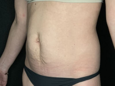 Patient #12339: Tummy Tuck Before Image