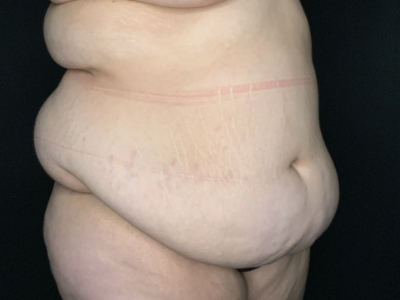 Patient #23698: Tummy Tuck with Liposuction to Flanks and Back Before Image