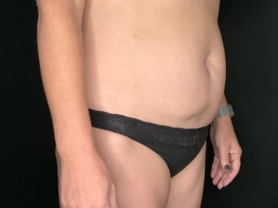 Patient #89658: Tummy Tuck with Liposuction to Flanks Before Image