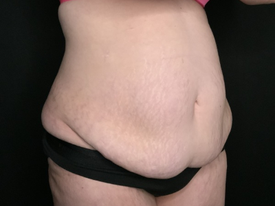 Patient #69856: Tummy Tuck with Liposuction to Flanks Before Image