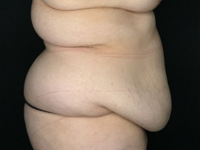 Patient #23698: Tummy Tuck with Liposuction to Flanks and Back Before Image