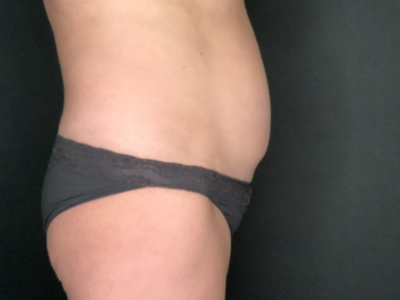 Patient #89658: Tummy Tuck with Liposuction to Flanks Before Image
