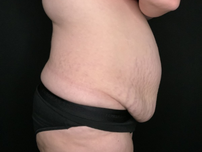 Patient #69856: Tummy Tuck with Liposuction to Flanks Before Image