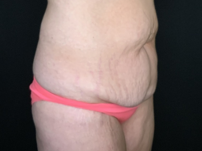 Patient #96587: Tummy Tuck with Liposuction to Flanks Before Image