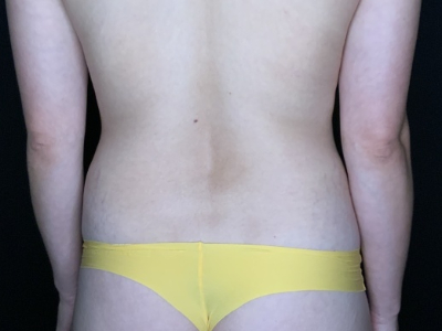 Patient #56985: Tummy Tuck with Flank Liposuction Before Image