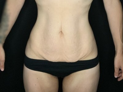 Patient #67891: Tummy Tuck Before Image