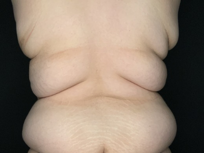Patient #23698: Tummy Tuck with Liposuction to Flanks and Back Before Image