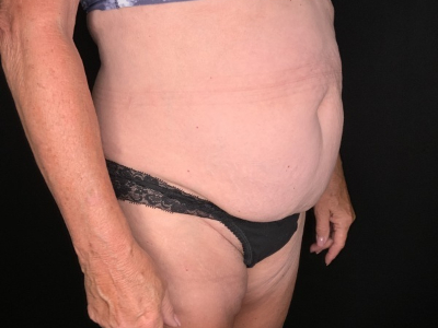 Patient #45698: Tummy Tuck with Liposuction to Flanks, Hips, and Abdomen Before Image