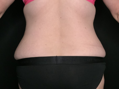 Patient #69856: Tummy Tuck with Liposuction to Flanks Before Image