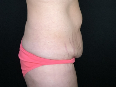 Patient #96587: Tummy Tuck with Liposuction to Flanks Before Image