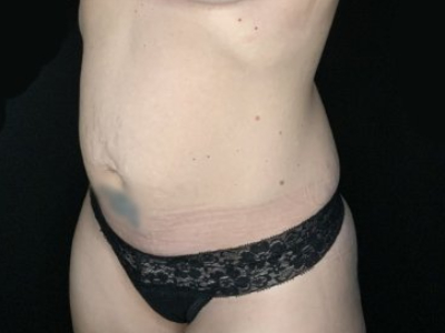 Patient #45696: Tummy Tuck Before Image