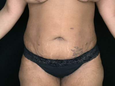 Patient #78963: Tummy Tuck with Liposuction to Flanks Before Image