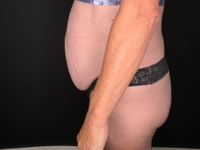 Patient #45698: Tummy Tuck with Liposuction to Flanks, Hips, and Abdomen Before Image