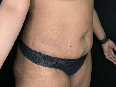 Patient #78963: Tummy Tuck with Liposuction to Flanks Before Image