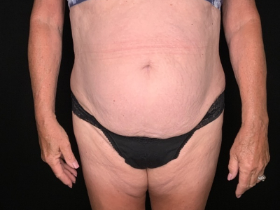 Patient #45698: Tummy Tuck with Liposuction to Flanks, Hips, and Abdomen Before Image