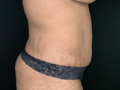 Patient #78963: Tummy Tuck with Liposuction to Flanks Before Image