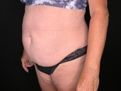 Patient #45698: Tummy Tuck with Liposuction to Flanks, Hips, and Abdomen Before Image