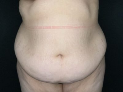 Patient #23698: Tummy Tuck with Liposuction to Flanks and Back Before Image