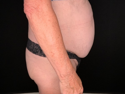 Patient #45698: Tummy Tuck with Liposuction to Flanks, Hips, and Abdomen Before Image