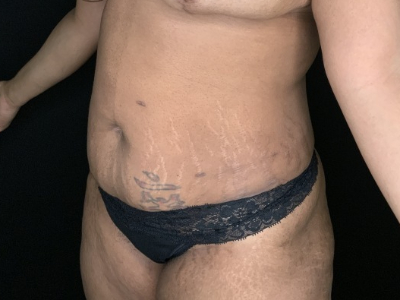 Patient #78963: Tummy Tuck with Liposuction to Flanks Before Image