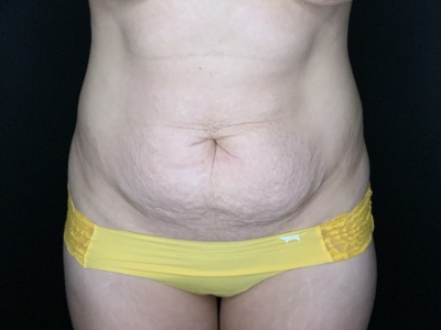 Patient #56985: Tummy Tuck with Flank Liposuction Before Image