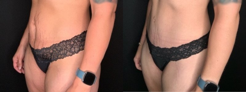 Patient #45863: Tummy Tuck with Liposuction to Hips, Flanks, Thighs Combine Image