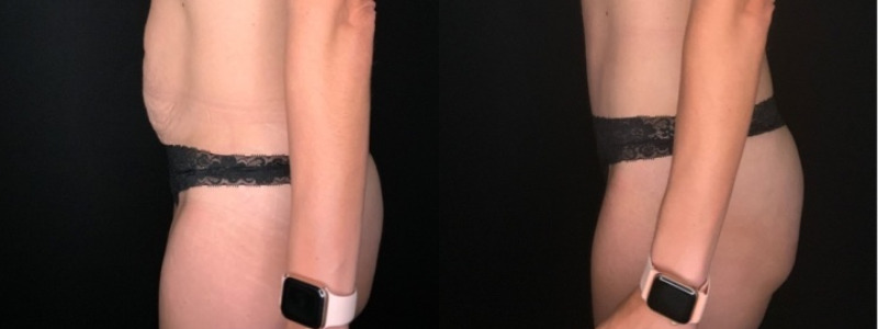 Patient #35698: Tummy Tuck with Liposuction to Flanks Combine Image