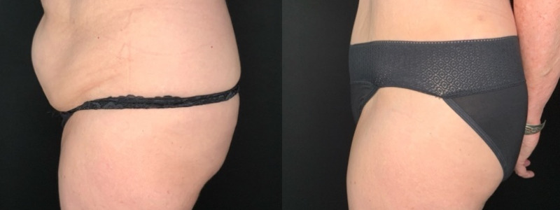 Patient #45682: Tummy Tuck with Liposuction to Flanks Combine Image