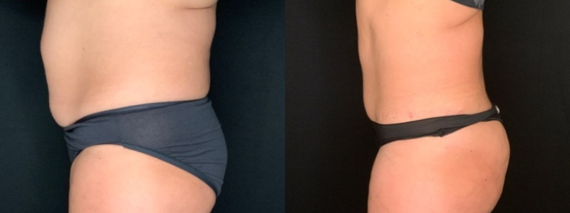 Patient #62875 Tummy Tuck with Liposuction to Back, Hips, Abdomen and Flanks Combine Image