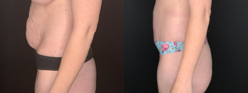 Patient #54673-2: Tummy Tuck with Liposculpture to Flanks and Axillary Rolls Combine Image