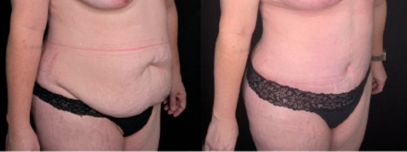 Patient #59874: Tummy Tuck Combine Image