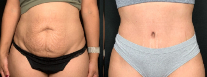 Patient #59852: Tummy Tuck Combine Image